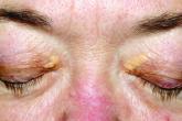 Lasers may be effective for treating xanthelasma