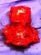 Surgery for early-stage cervical cancer: Are we still too radical?