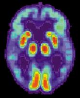 Blood-based signature helps predict status of early AD indicator