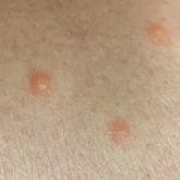 Clear vesicles on an erythematous base