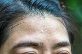 Hyperhidrosis