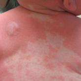 Flushing Lesion on 4-Month-Old Boy