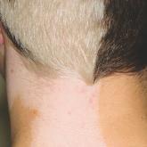 A Paler Patch of Skin