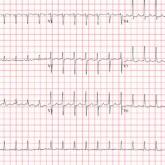 ECG
