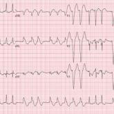 ECG