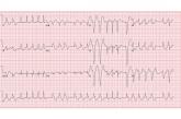 ECG