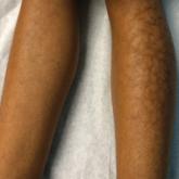 Reticular Hyperpigmentation on the Lower Legs