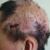 An Unusual Case of Folliculitis Spinulosa Decalvans