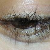 Beaded Papules Along the Eyelid Margins 
