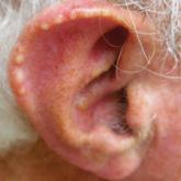 Using the Blanch Sign to Differentiate Weathering Nodules From Auricular Tophaceous Gout