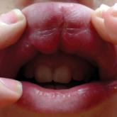 Granulomatous Cheilitis Mimicking Angioedema