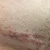 Verrucous Coalescing Dry Papules and Plaques on the Hip and Flank
