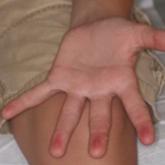 Blanchable Erythematous Patches on the Fingers