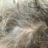 Pityriasis Amiantacea Following Bone Marrow Transplant