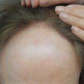 Frontal Fibrosing Alopecia Demographics: A Survey of 29 Patients