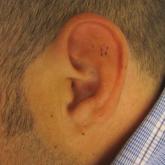 Relapsing Polychondritis in Human Immunodeficiency Virus
