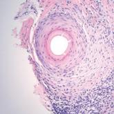 Graham-Little-Piccardi-Lassueur Syndrome