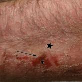 Allergic Contact Dermatitis With Sparing of Exposed Psoriasis Plaques