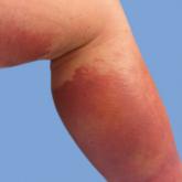 Acroangiodermatitis of Mali and Stewart-Bluefarb Syndrome