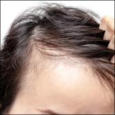 Nonsurgical Hair Restoration Treatment
