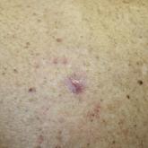 Clinical Pearl: Topical Timolol for Refractory Hypergranulation