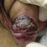 Pulmonary Hemorrhage as the Initial Presentation of AIDS-Related Kaposi Sarcoma