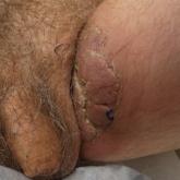 Cutaneous Pemphigus Vegetans Co-occurring With Oral Pemphigus Vulgaris