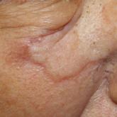 Angiosarcoma Imitating a Morpheaform Basal Cell Carcinoma
