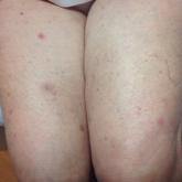 Disseminated Erythema Induratum in a Patient With a History of Tuberculosis