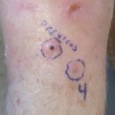 Field Cancerization With Multiple Keratoacanthomas Successfully Treated With Topical and Intralesional 5-Fluorouracil