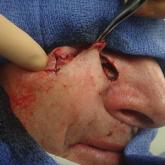 Z-plasty for Correction of Standing Cutaneous Deformity