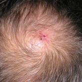 Scalp Arteriovenous Fistula With Intracranial Communication