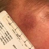 Telangiectatic Patch on the Forehead