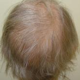 Permanent Alopecia in Breast Cancer Patients: Role of Taxanes and Endocrine Therapies