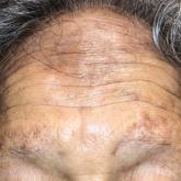 Hyperpigmentation on the Head and Neck