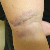 Erethism Mercurialis and Reactions to Elemental Mercury