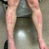 Apremilast Uses and Relevance to the Military