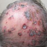 Exuberant Lymphomatoid Papulosis of the Head and Upper Trunk