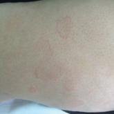 Urticarial Vasculitis Successfully Treated With Omalizumab