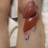 Cutaneous Complications Associated With Intraosseous Access Placement