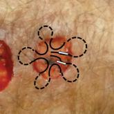 Wound Healing on the Dorsal Hands: An Intrapatient Comparison of Primary Closure, Purse-String Closure, and Secondary Intention