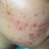 Results of Laboratory Monitoring in Patients Taking Isotretinoin for Acne