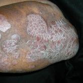 Psoriasis