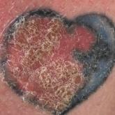 Verruca Vulgaris Arising Within the Red Portion of a Multicolored Tattoo