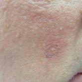 Overlapping Phenotypic Features of PTEN Hamartoma Tumor Syndrome and Birt-Hogg-Dubé Syndrome