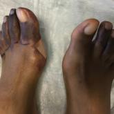 Botulinum Toxin for the Treatment of Intractable Raynaud Phenomenon