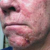 Phototoxicity Secondary to Home Fireplace Exposure After Photodynamic Therapy for Actinic Keratosis