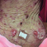 TANS Syndrome: Tanorexia, Anorexia, and Nonmelanoma Skin Cancer