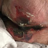 Retiform Purpura on the Buttocks in 6 Critically Ill COVID-19 Patients