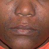 Seborrheic Dermatitis